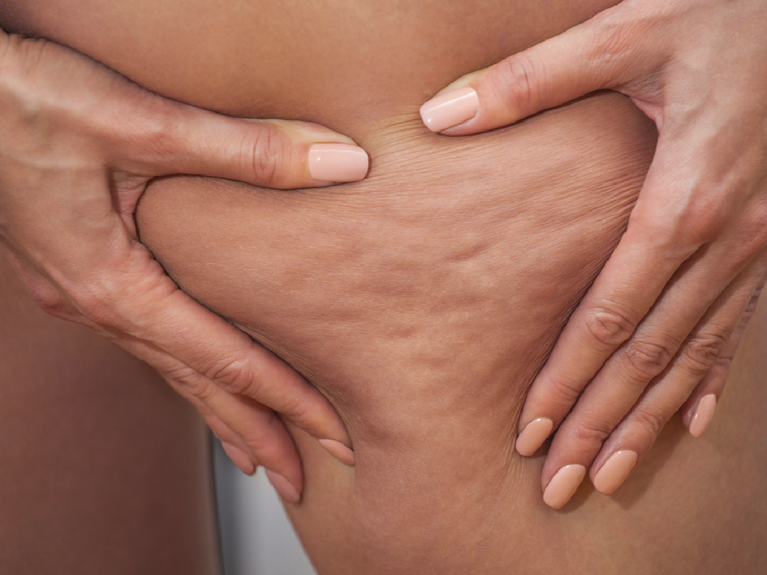 Estudio revela que se puede reducir                 la celulitis en un 90% de los pacientes 