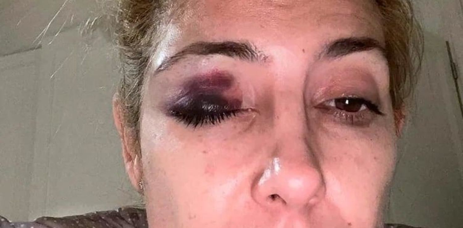 Revelaron nuevas fotos de Fabiola Yáñez con la cara golpeada