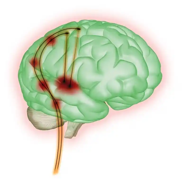 Una forma de epilepsia que se inicia en la infancia: por qué es clave el diagnóstico temprano
