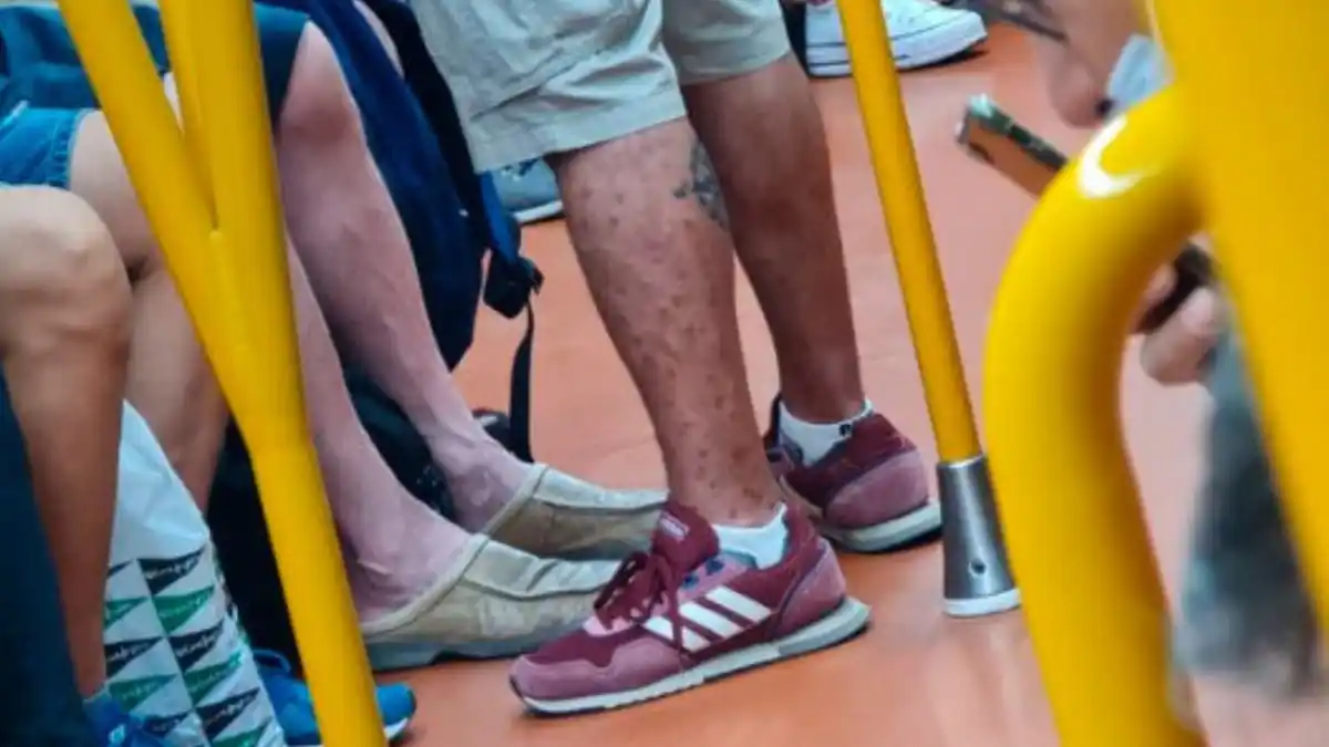 Un médico detectó en el tren a un infectado con viruela del mono