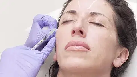 Toxina botulínica: cómo funciona el tratamiento para atenuar arrugas en rostro y cuello.