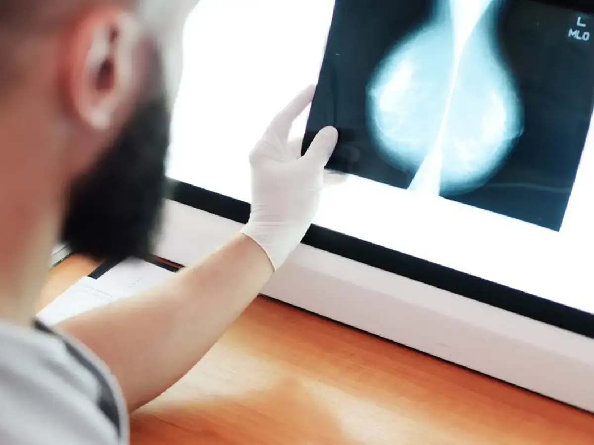 Diagnosticaron con cáncer de mama a una niña chilena: un caso raro en el mundo
