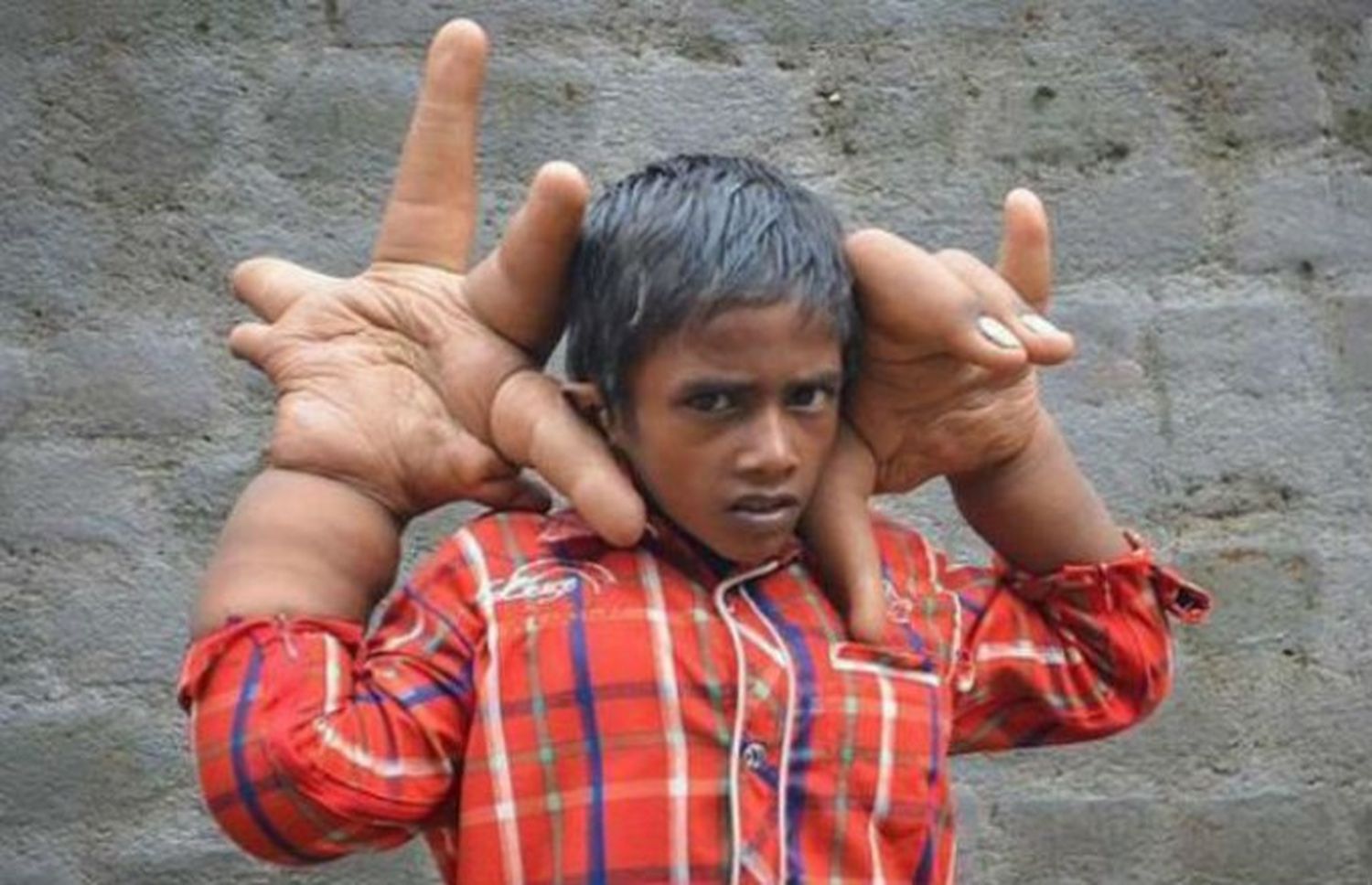 Un niño de 8 años con manos gigantes causa furor en India