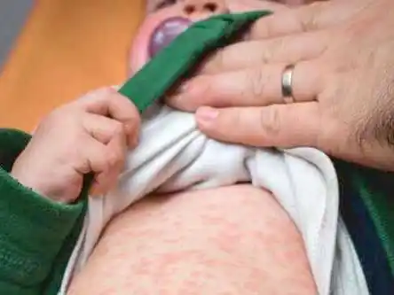 Sarampión: notificaron 4 nuevos casos en Argentina