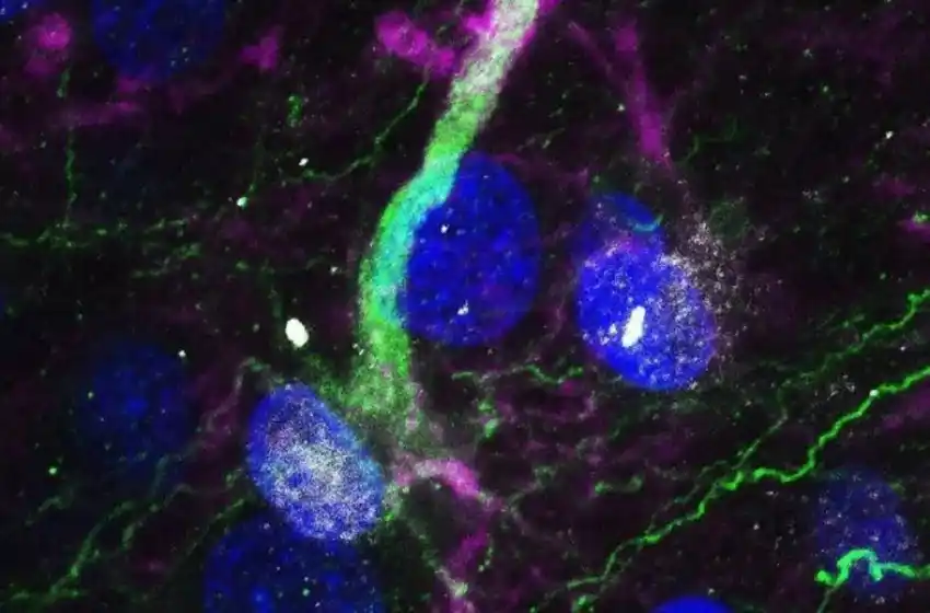 Un estudio comprobó que la acumulación de una proteína permite la detección temprana del Parkinson