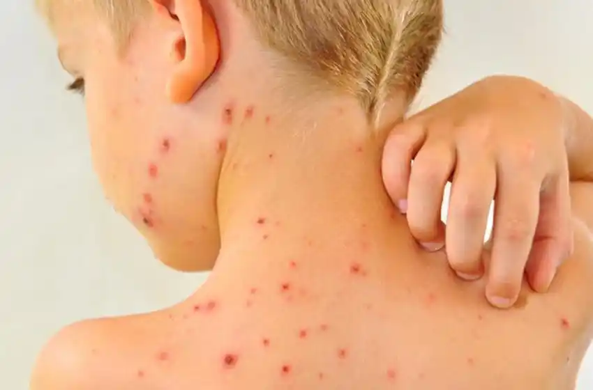 Alerta por sarampión: recomiendan vacunarse antes de viajar al exterior