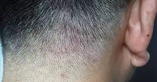 El hongo se puede diseminar por todo el cuerpo y produce la alopecia.