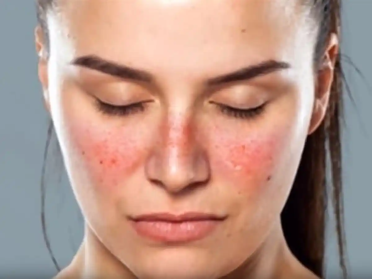 El impacto del lupus en el bienestar: destacan la necesidad de educación y apoyo emocional