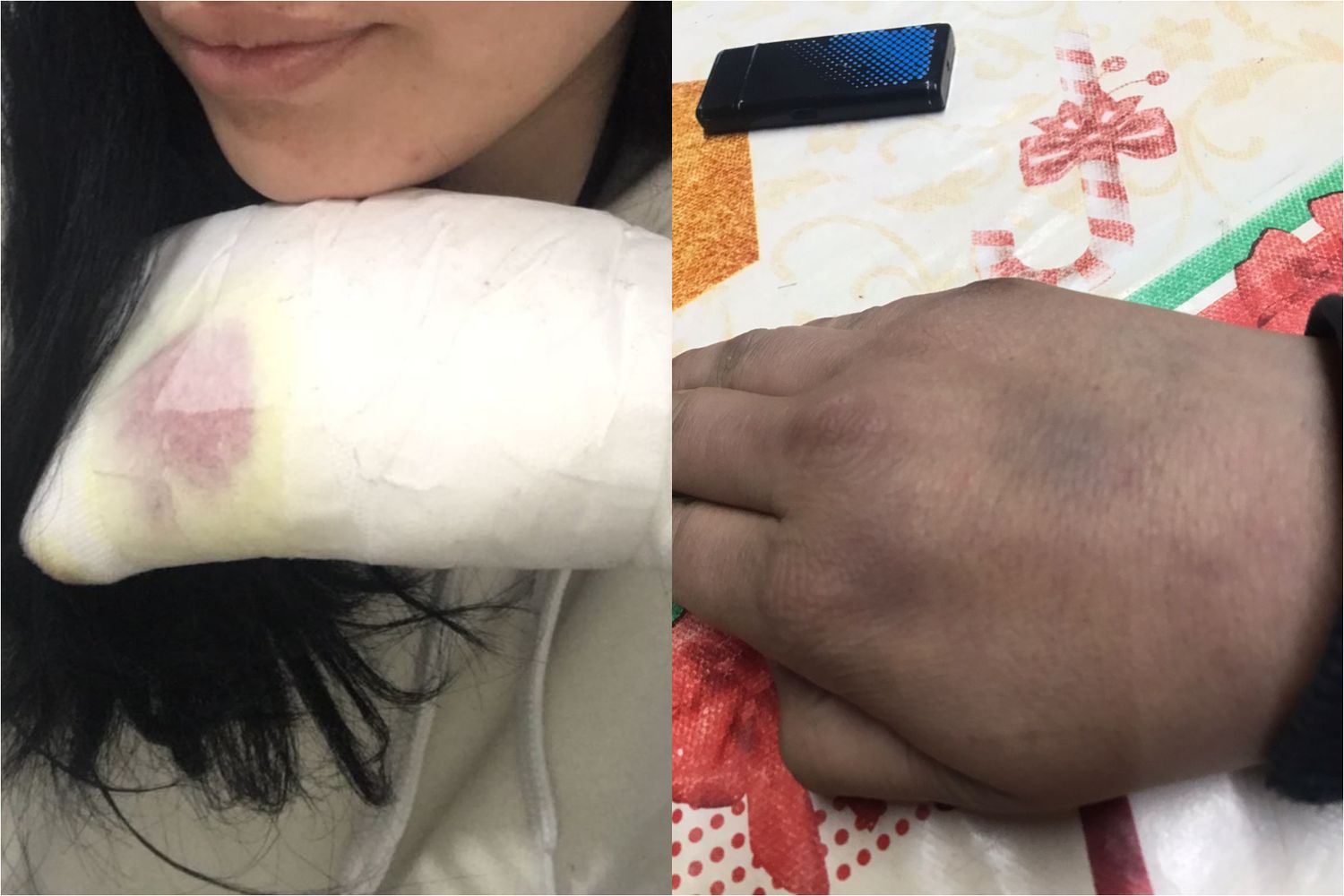 La joven compartió imágenes de las heridas.