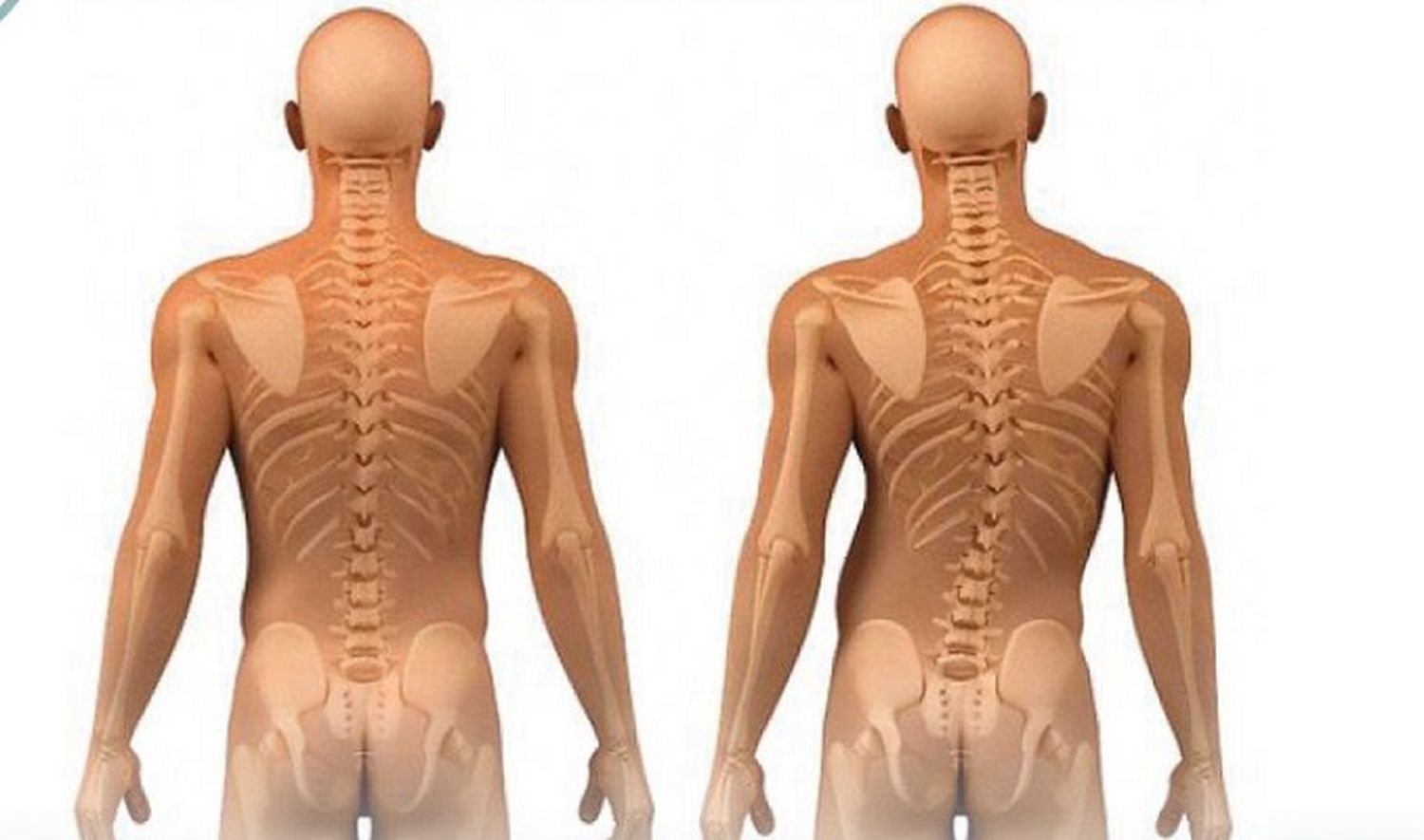 Escoliosis: ¿los ejercicios terapéuticos tienen que formar parte del tratamiento?
