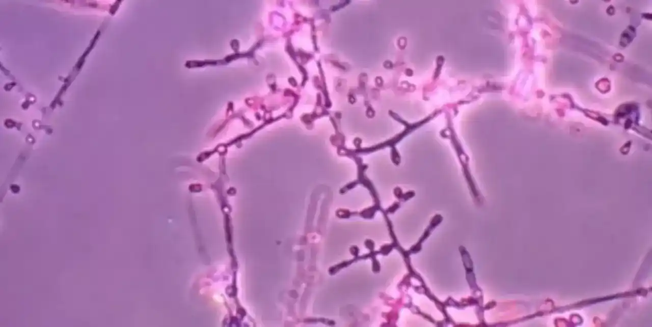 Alerta en Estados Unidos por casos de tiña resistente al tratamiento