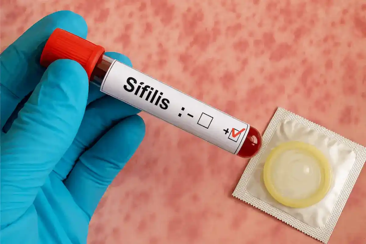 Advierten que la sífilis volvió a ser un problema de salud pública en Gualeguaychú