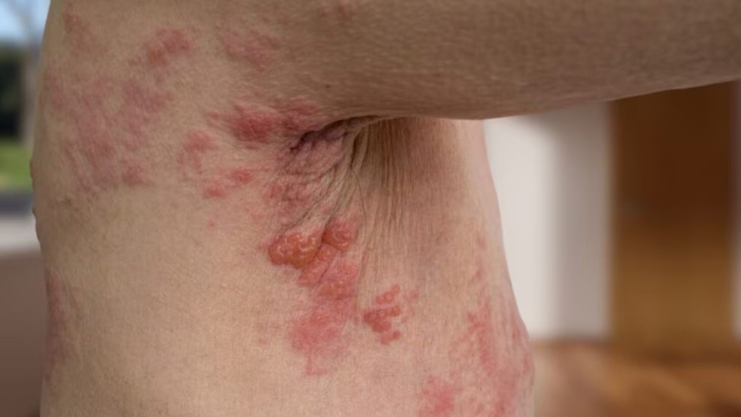El herpes zóster afecta cada vez a más adultos mayores y genera preocupación médica por sus secuelas