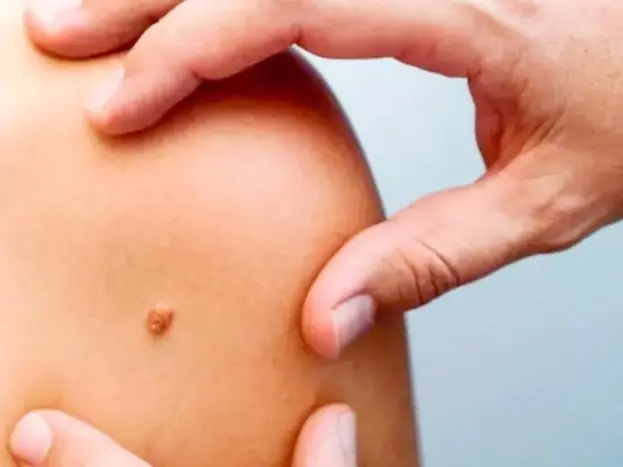 Habilitan en el país la vacuna para tratar  melanoma de alto riesgo