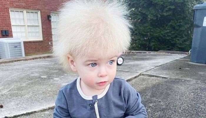 Qué es el �SSíndrome del cabello  impeinable⬝, la patología  que afecta a un niño en EE. UU.