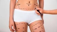 Aspectos a tener en cuenta a la hora de pensar en una lipoescultura