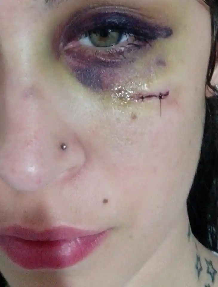 Su ex le deformó la cara y ella lo denunció en Facebook