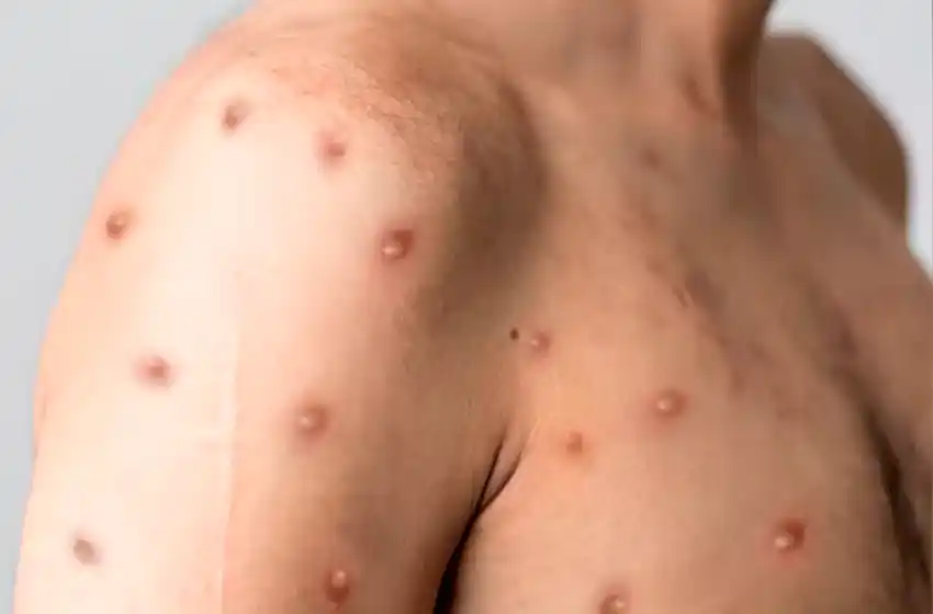 Dos nuevos casos sospechosos de viruela del mono en Rosario