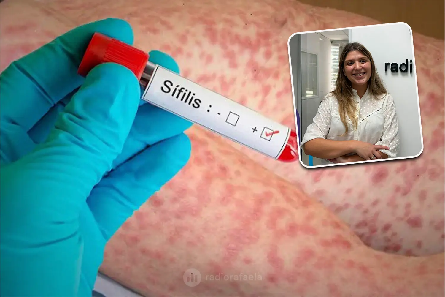 Crecieron los casos de sífilis en Rafaela: "Lamentablemente se le perdió el miedo al HIV y no usan preservativo"