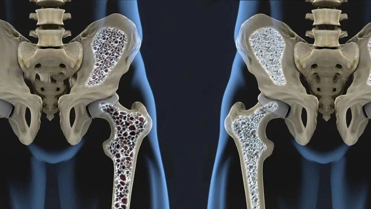 Osteoporosis, una epidemia silenciosa: estas son las causas