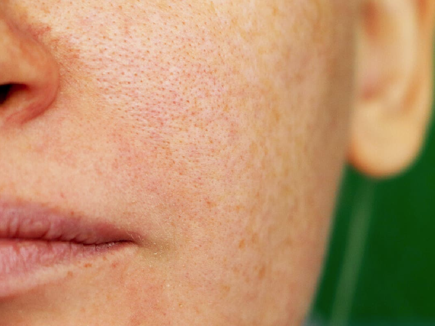 Ni bigotes ni manchas:  es melasma 