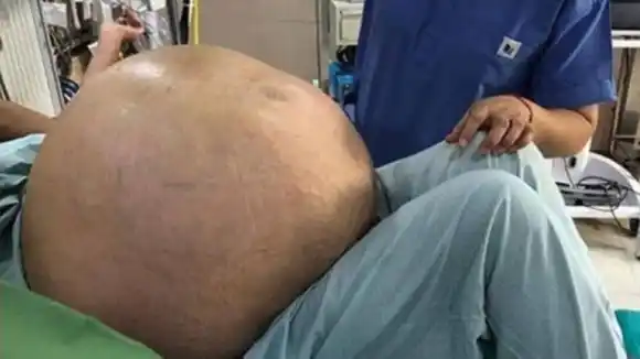¡HABÍA NOTADO UN AUMENTO DE PESO! Mujer fue operada de un tumor en el abdomen de más de 50 kilos