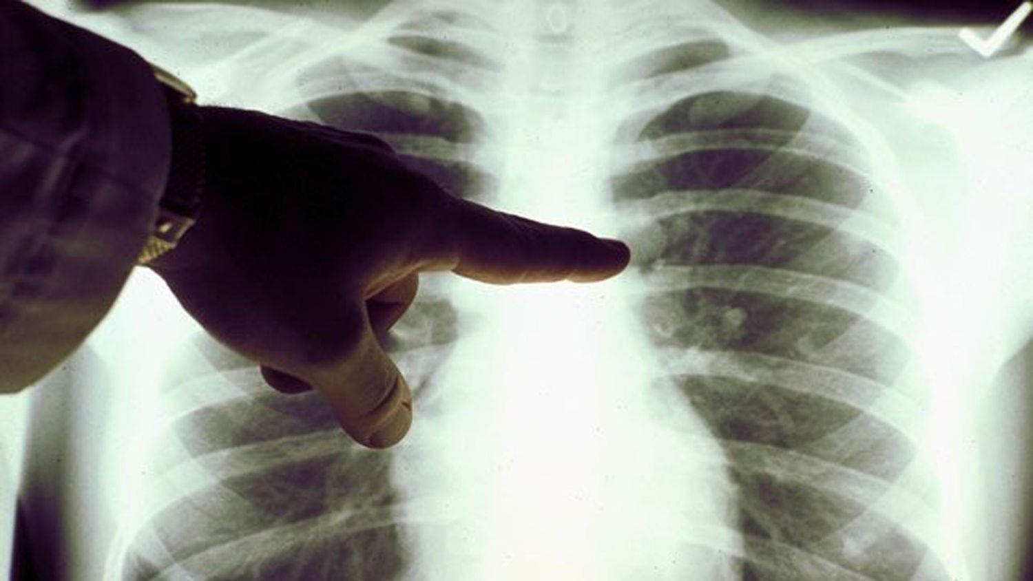 Inmunoterapia en cáncer de pulmón, un camino hacia la cronicidad de la enfermedad