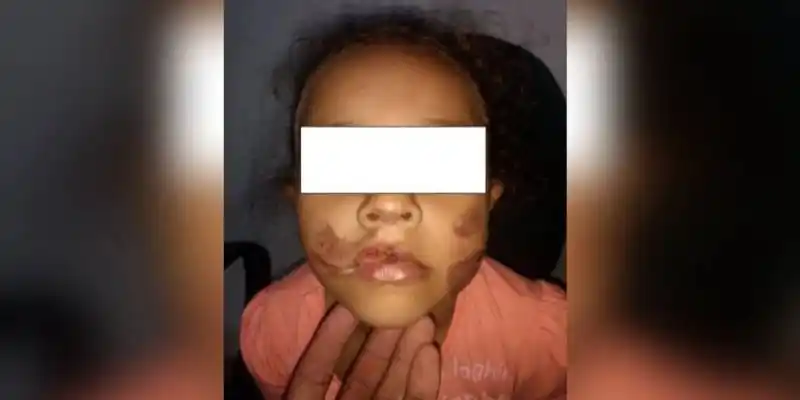 LE QUEMÓ la cara a su hija de 7 años por comer a escondidas
