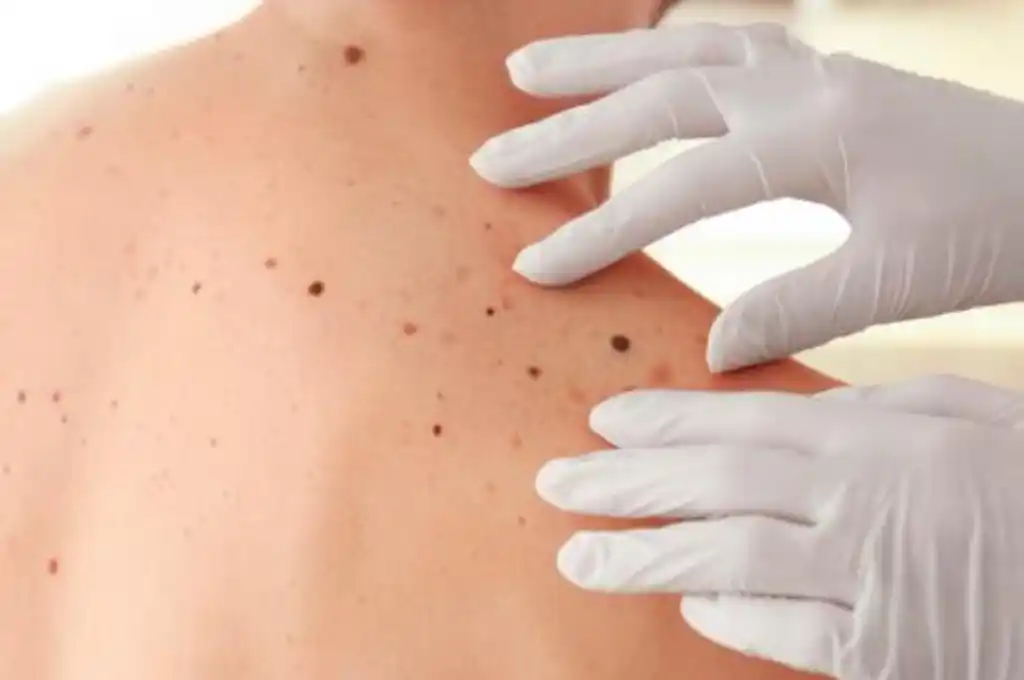 Melanoma: el cáncer del piel que afecta a Beto Casella