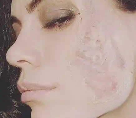 ¿Qué le pasó a Emilia Attias en cara?