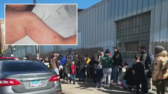 ¡PARA REMATAR! Brote de sarampión afecta albergue de migrantes en Chicago