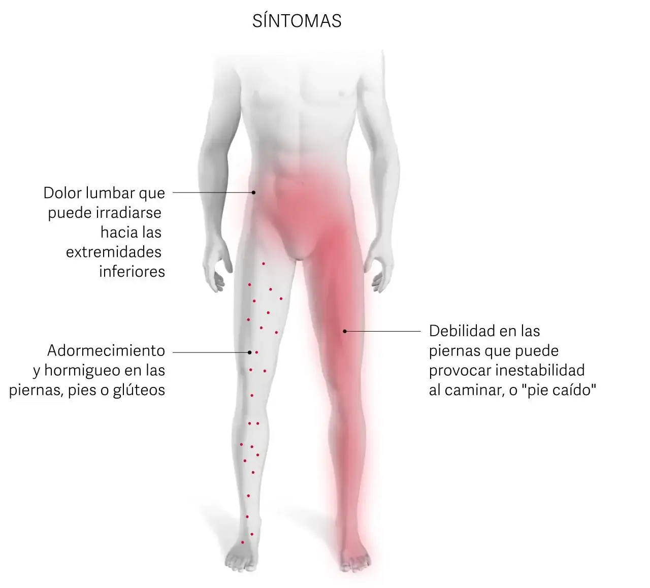 El dolor de espalda que aparece al caminar y desaparece al sentarse: no es solo un problema de la edad