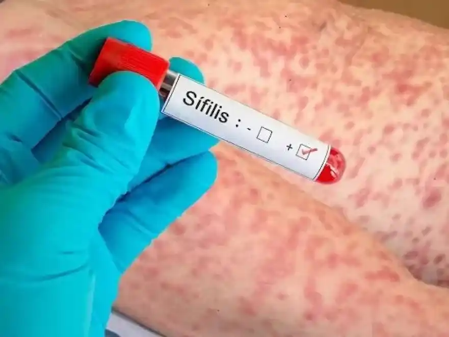 La sífilis registra su mayor número de casos desde que existen registros oficiales en la Argentina