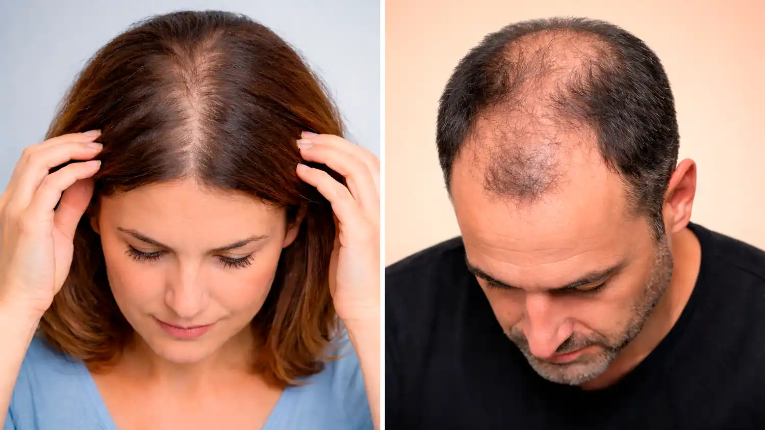 alopecia 2