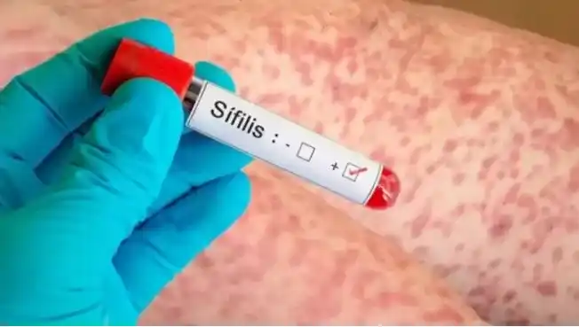 Alarmante aumento de la sífilis en Entre Ríos: Los casos confirmados crecieron más del 65% en el último año
