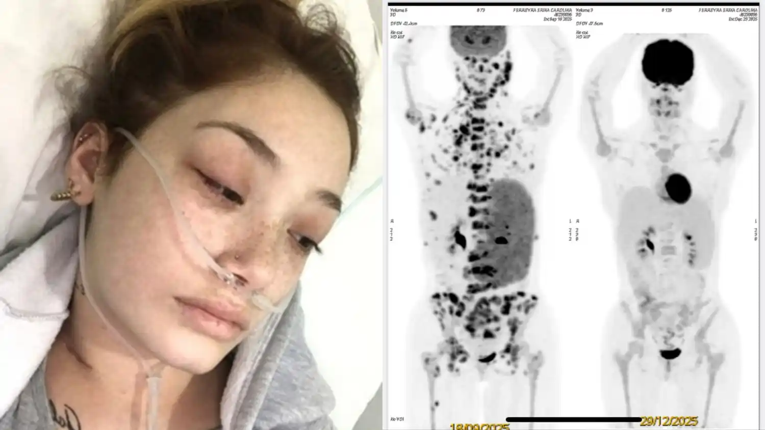 Erika padece Linfoma de Hodgkin, una enfermedad que afecta el sistema linfático.