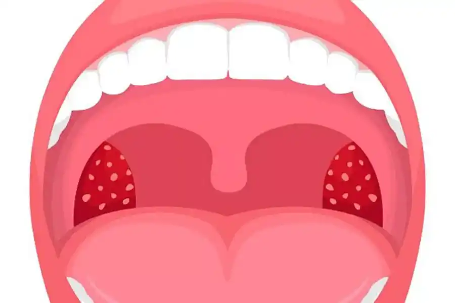 Amigdalitis: una afección que es más frecuente en niños 