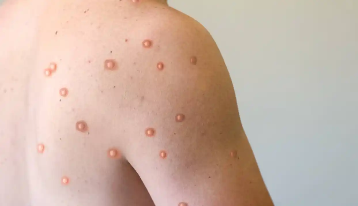 Mpox o viruela símica: hay ocho casos detectados en Argentina y se profundiza la vigilancia