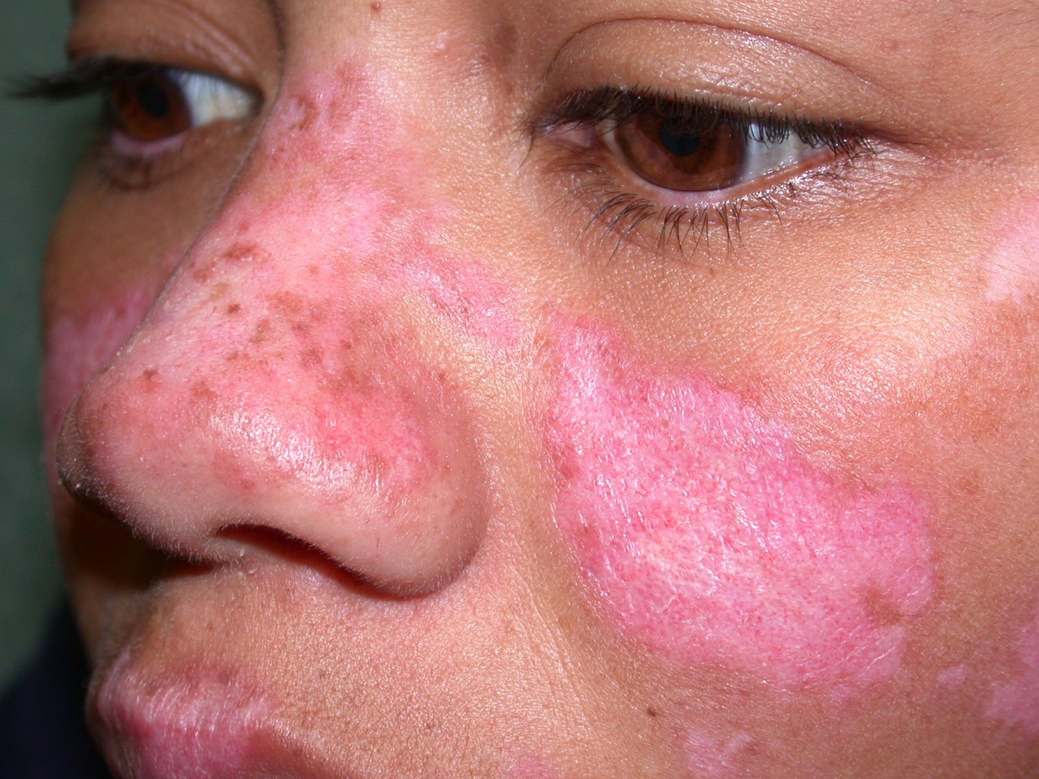 Lupus, la enfermedad autoinmune que azota al cuerpo