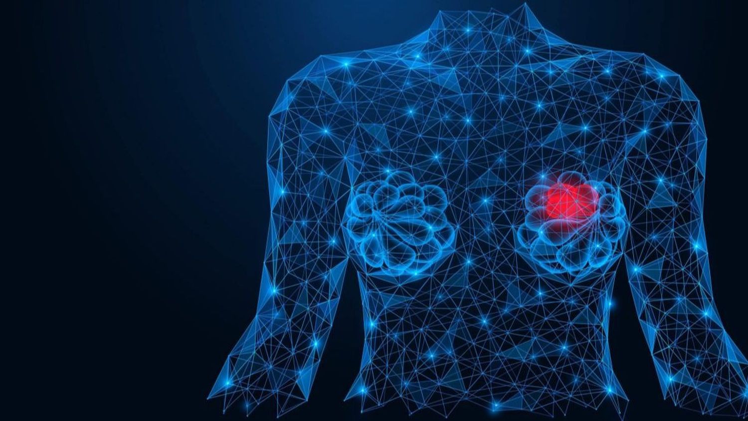 IA revoluciona la detección del cáncer de mama: examinan mamografías con precisión