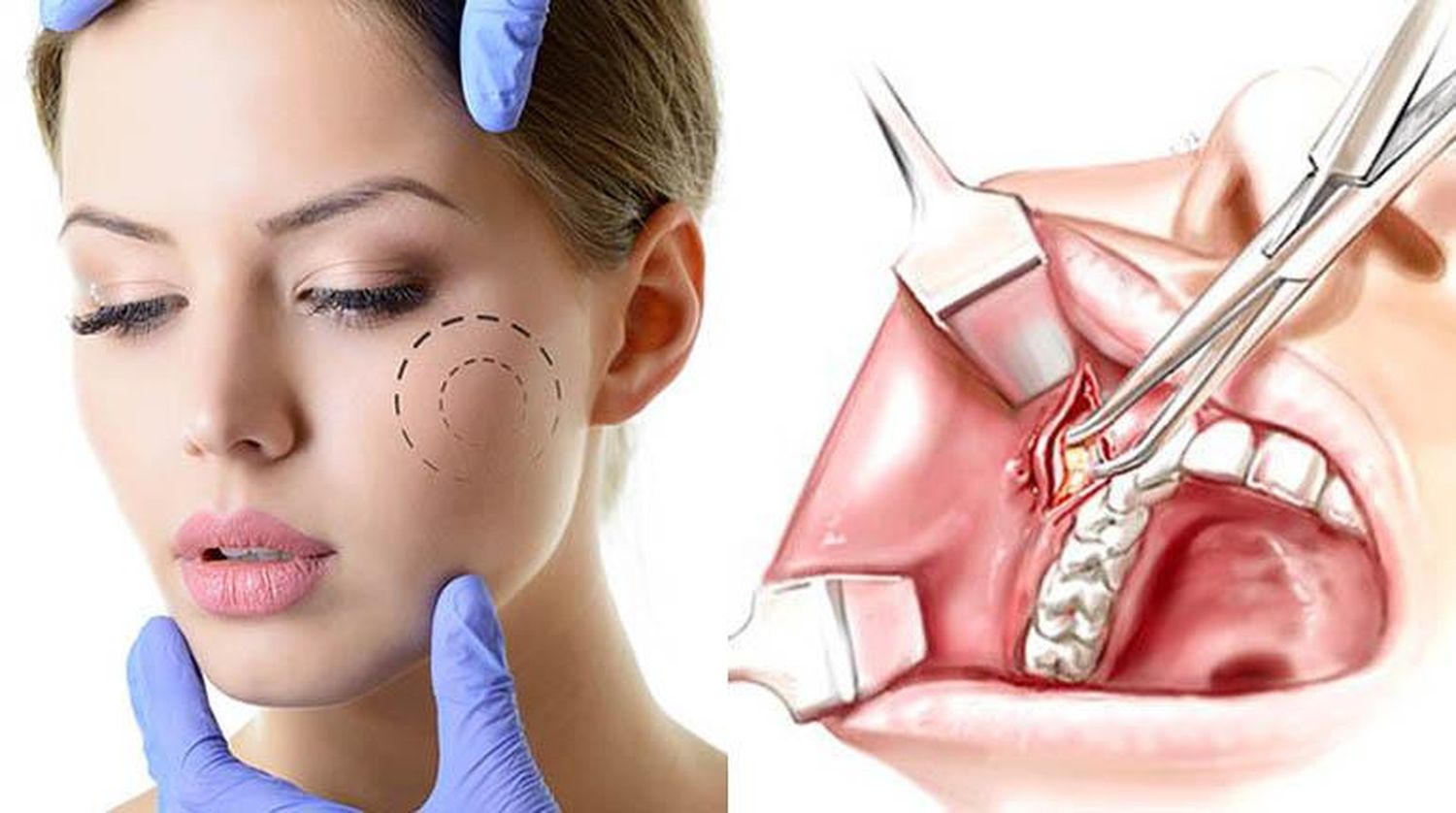 Como obtener un Rostro Anguloso de manera mininvasiva