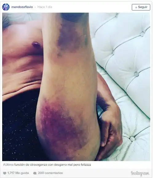 ¡Eso duele! Flavio Mendoza mostró su pierna desgarrada