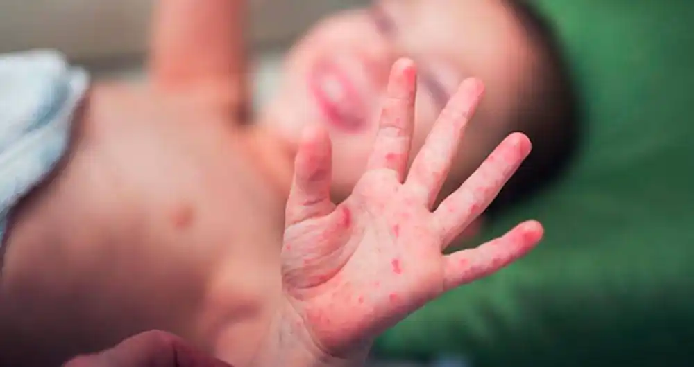 Estados Unidos ya tiene 555 casos de sarampión confirmados