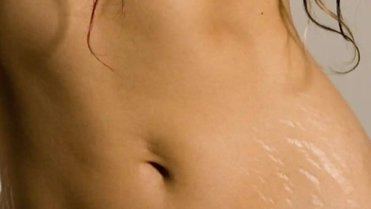 ¡AL FIN! Conozca los pasos para acabar con las estrías