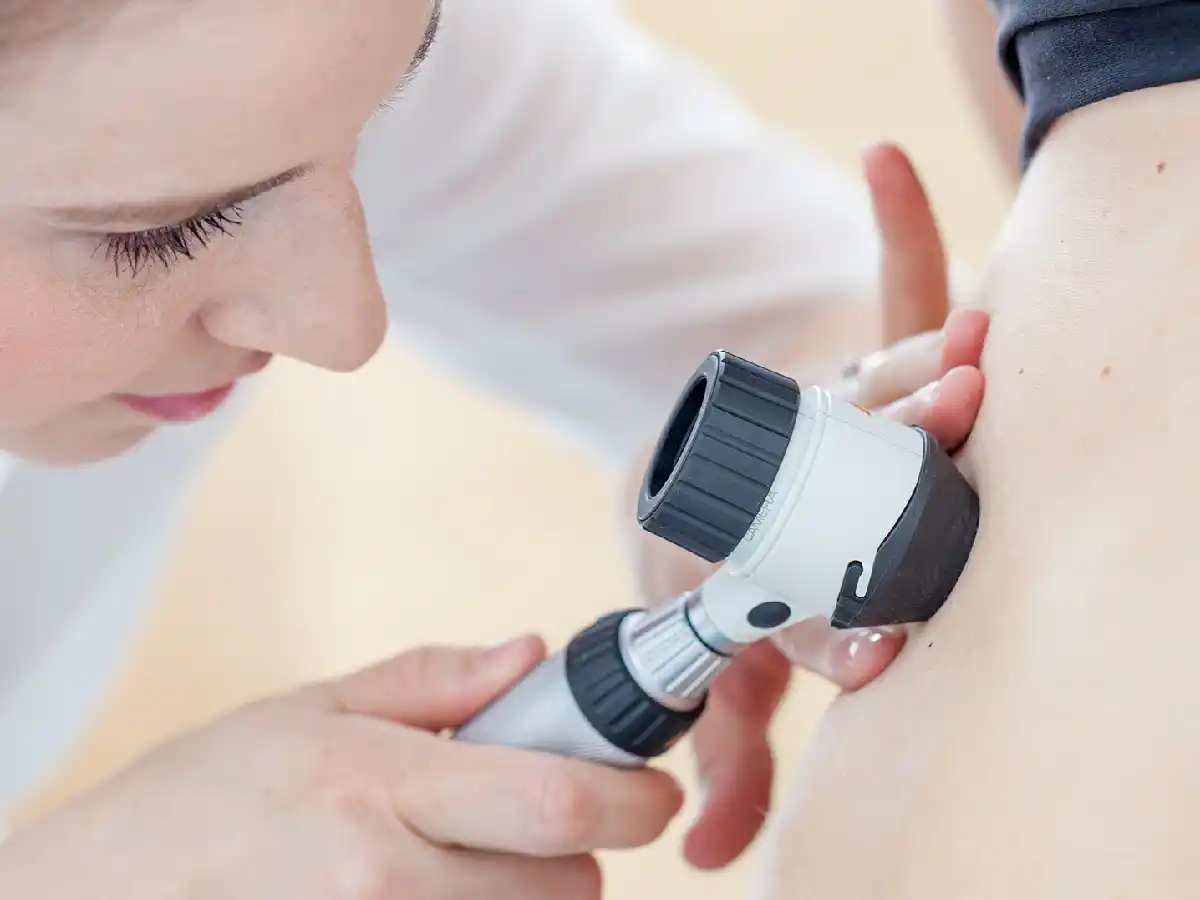 Melanoma: advierten sobre aumento de los casos en Latinoamérica   