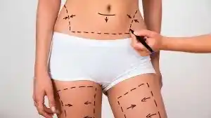 Aspectos a tener en cuenta a la hora de pensar en una lipoescultura