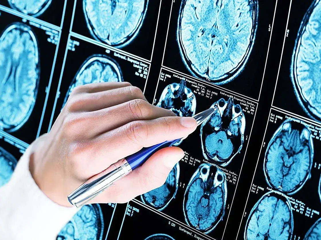 Realizan con éxito en Londres la primera cirugía cerebral del mundo asistida por inteligencia artificial en tiempo real