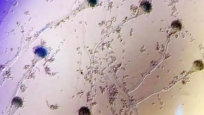 Detectan un hongo que causa infección en pacientes graves con coronavirus