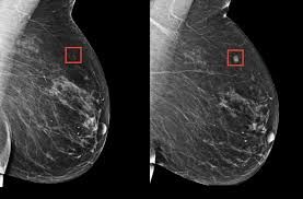 IA puede identificar mujeres con RIESGO ELEVADO DE CÁNCER DE MAMA varios años antes del diagnóstico