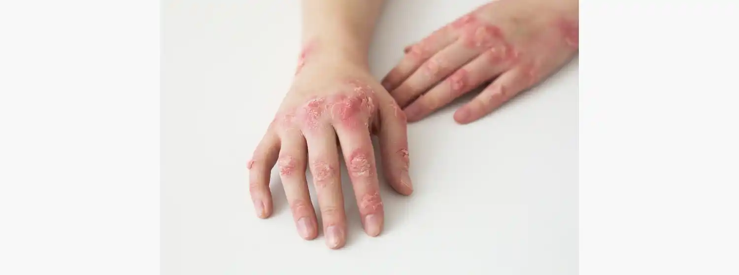 ¿Qué es el Herpes Zoster?